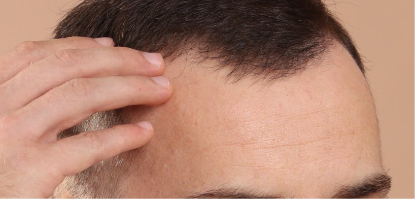 diffuse thinning treatment