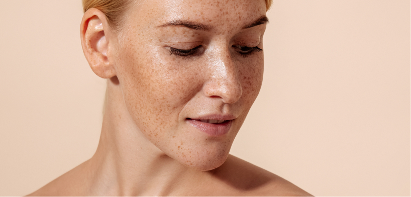 Hyperpigmentation & melasma