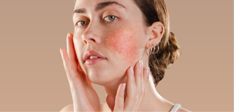 Redness rosacea