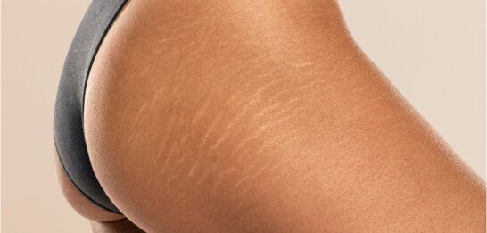 Scars & Stretchmarks