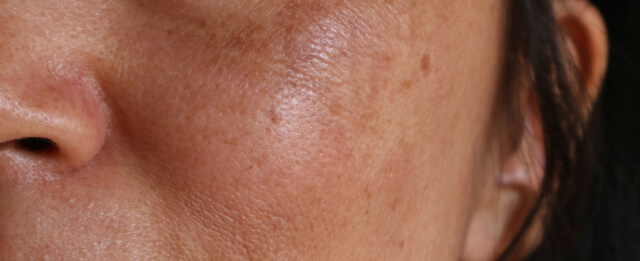 Melasma