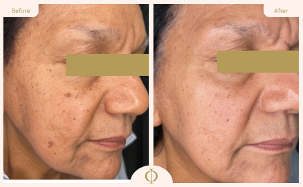 Pigmentation Treatment Results 2