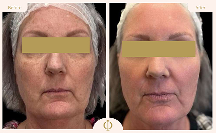Pigmentation Treatment Results 4