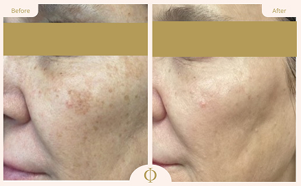 Pigmentation Treatment Results 5
