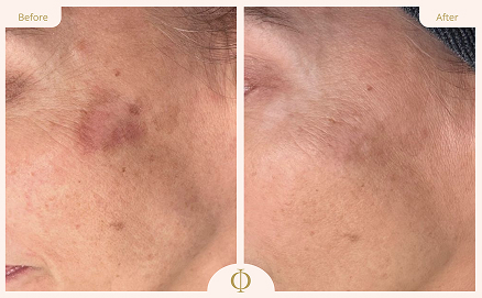 Pigmentation Treatment Results 6
