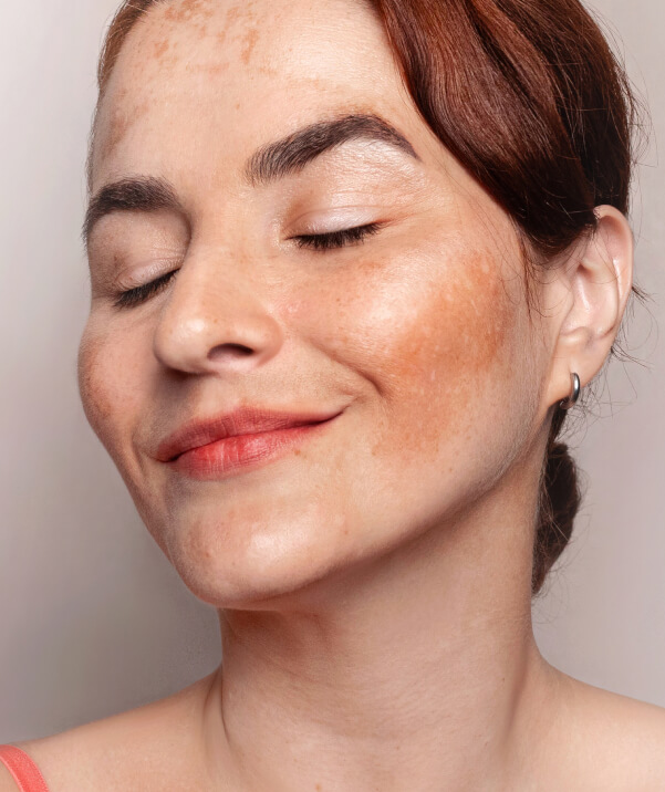 Hyperpigmentation