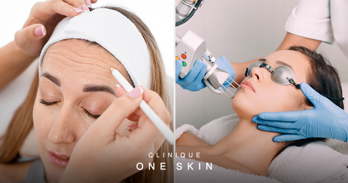 CO2 Laser vs Botox