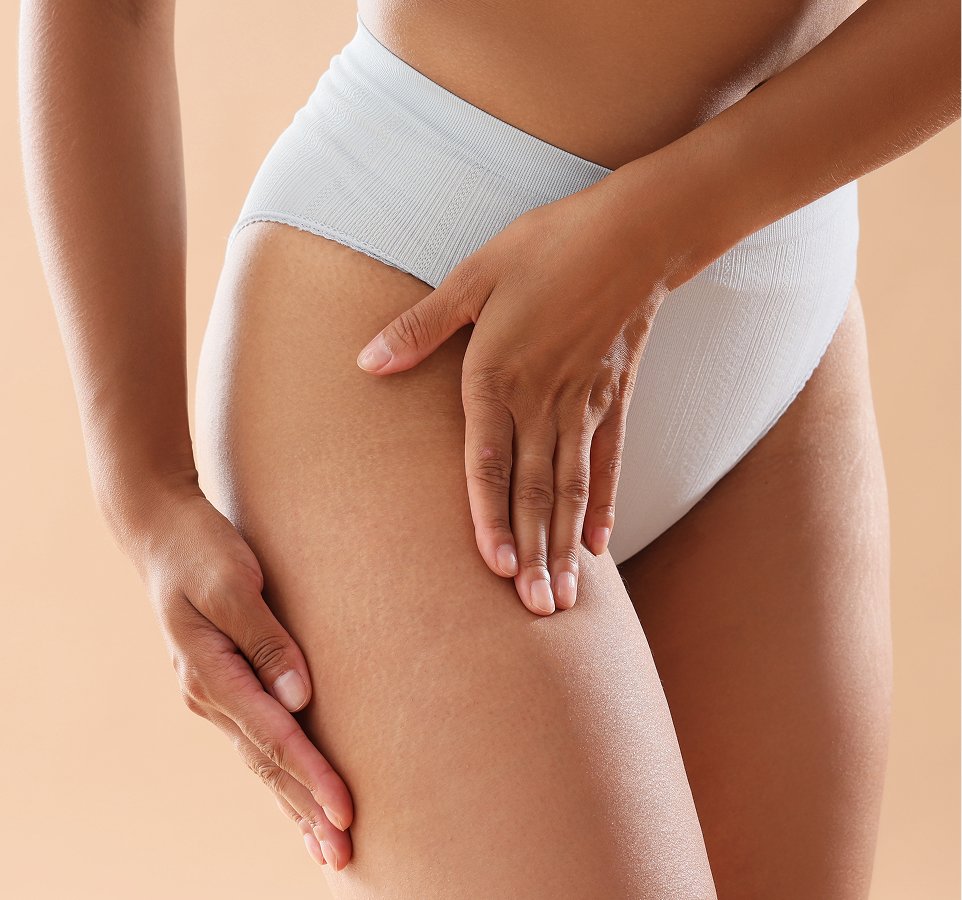 stretch marks causes