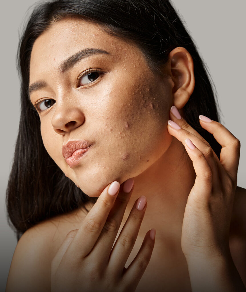 Acne Scarring and Texture default