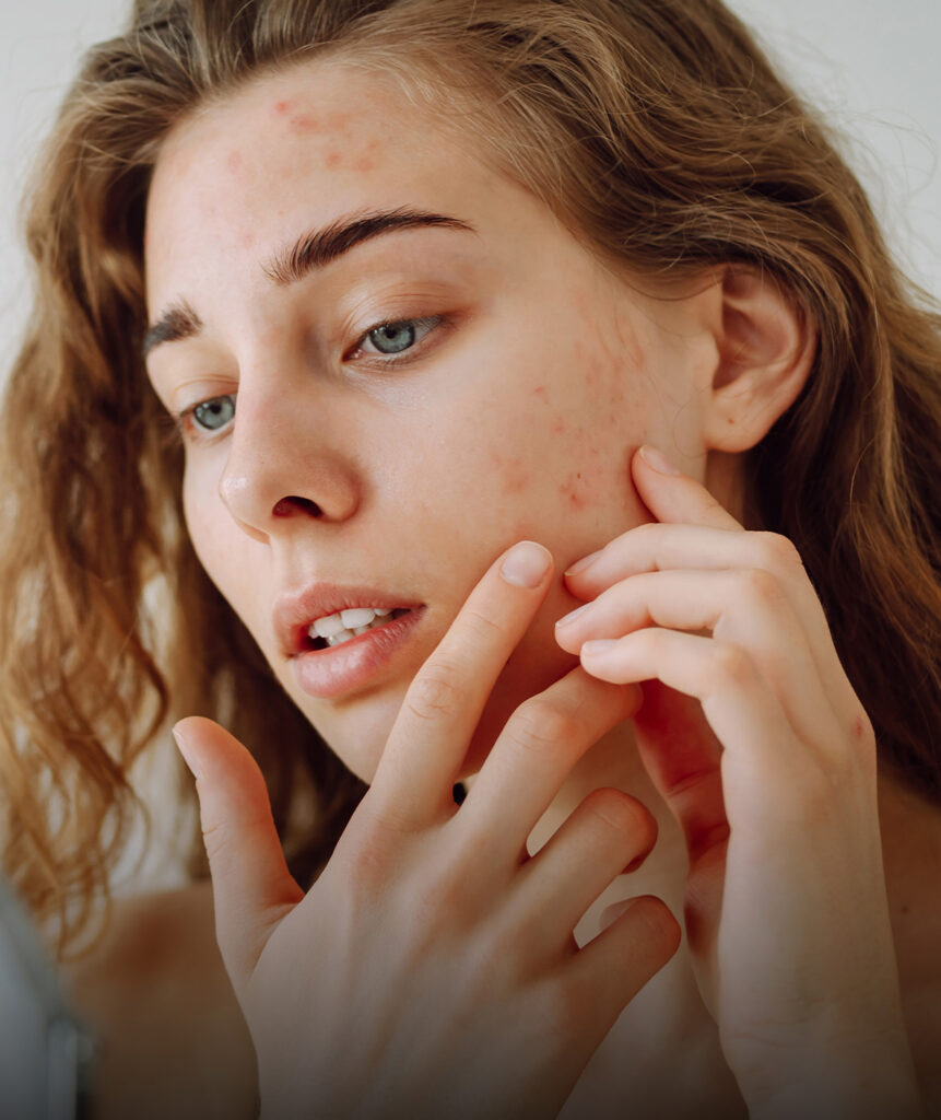 Active Acne default