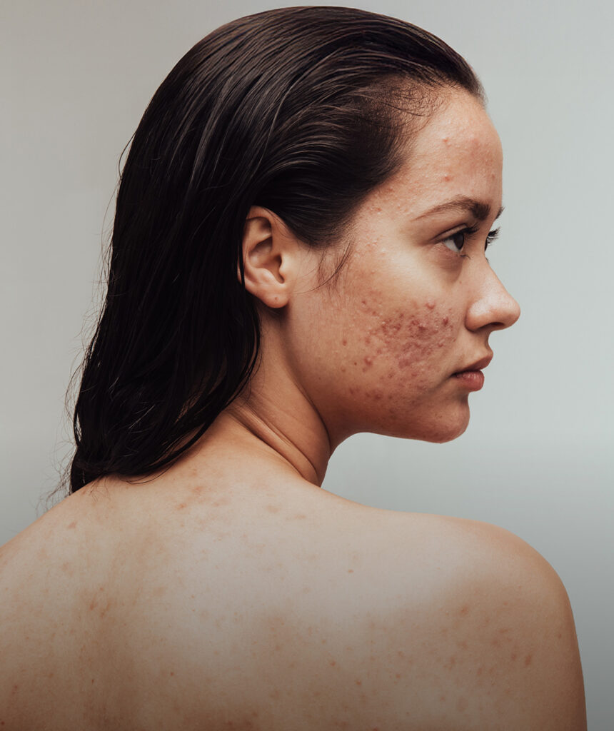 Active Breakouts and Inflammation default