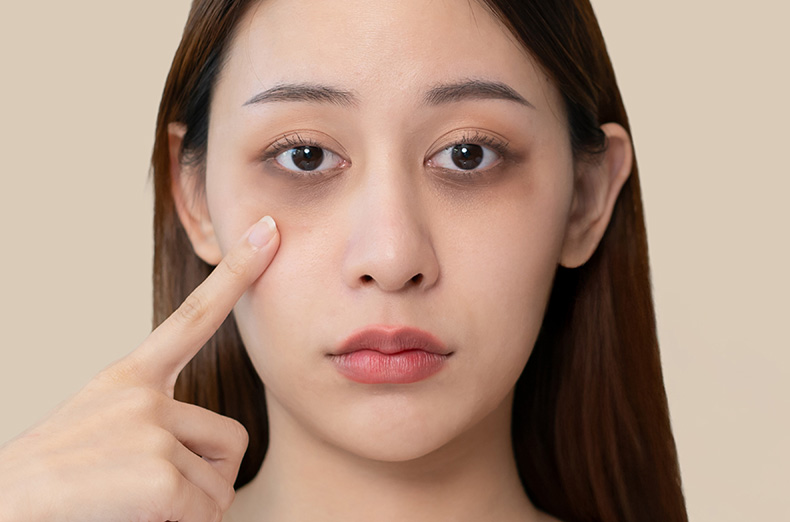 dark circles