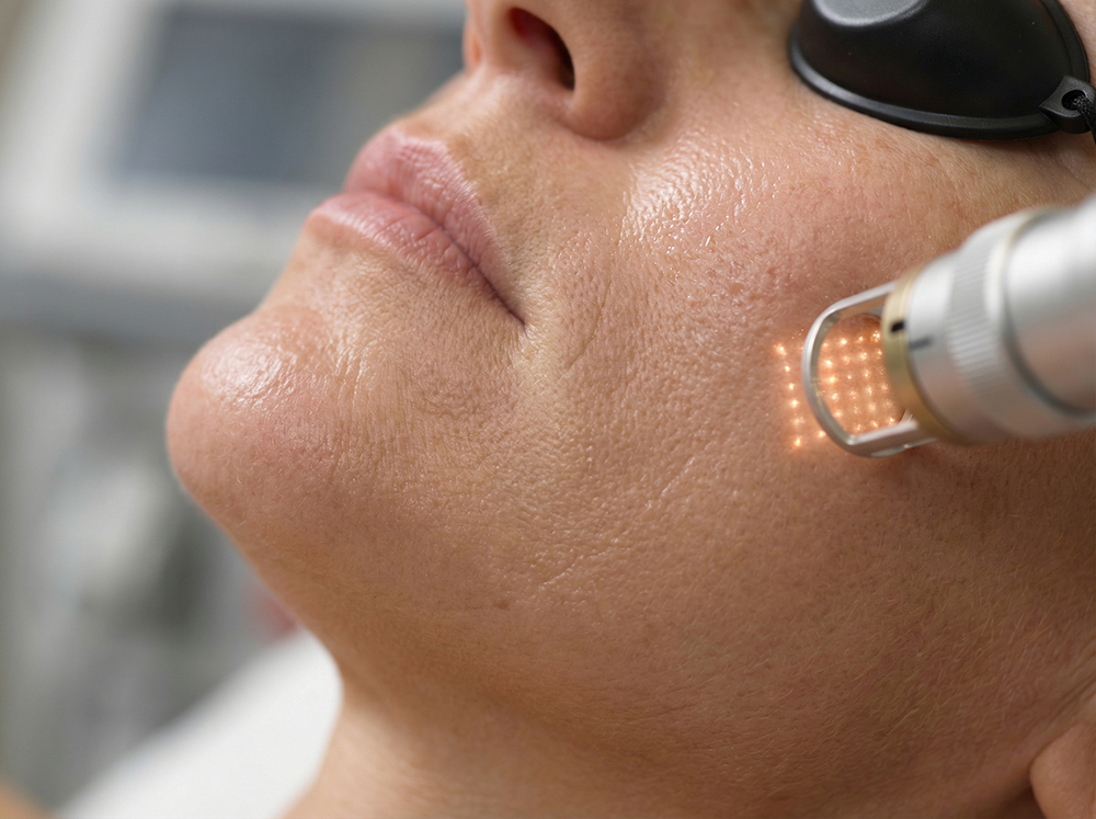 How Many Laser Resurfacing Sessions Are Needed