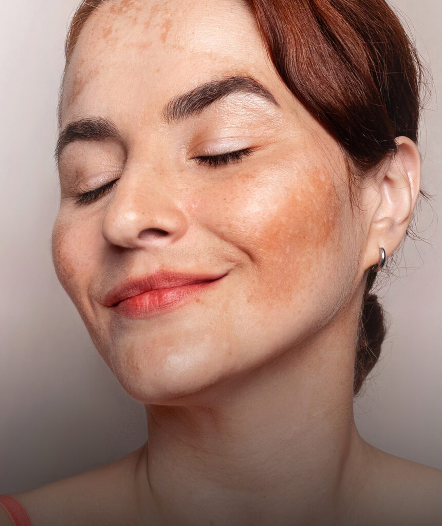 Hyperpigmentation default