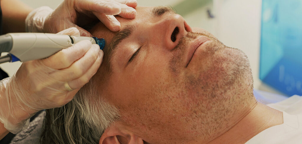 microneedling 1