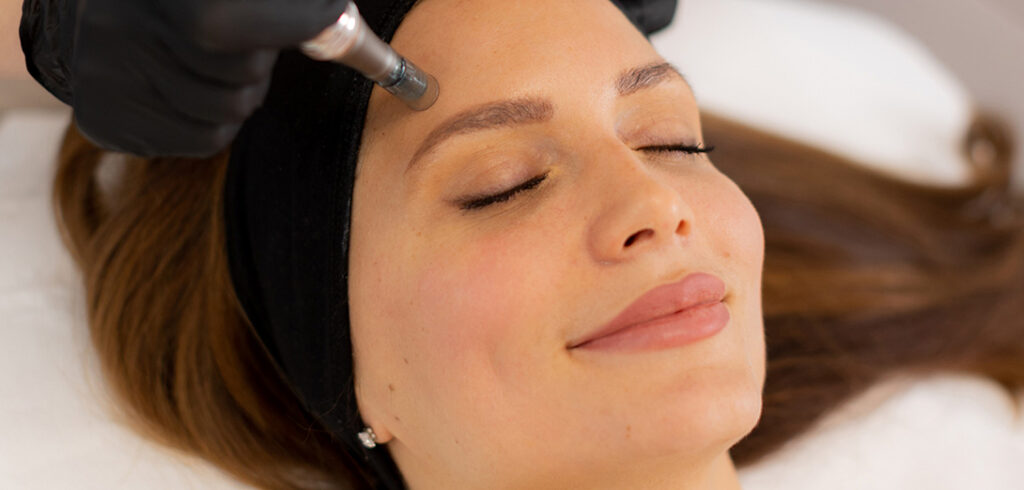 microneedling