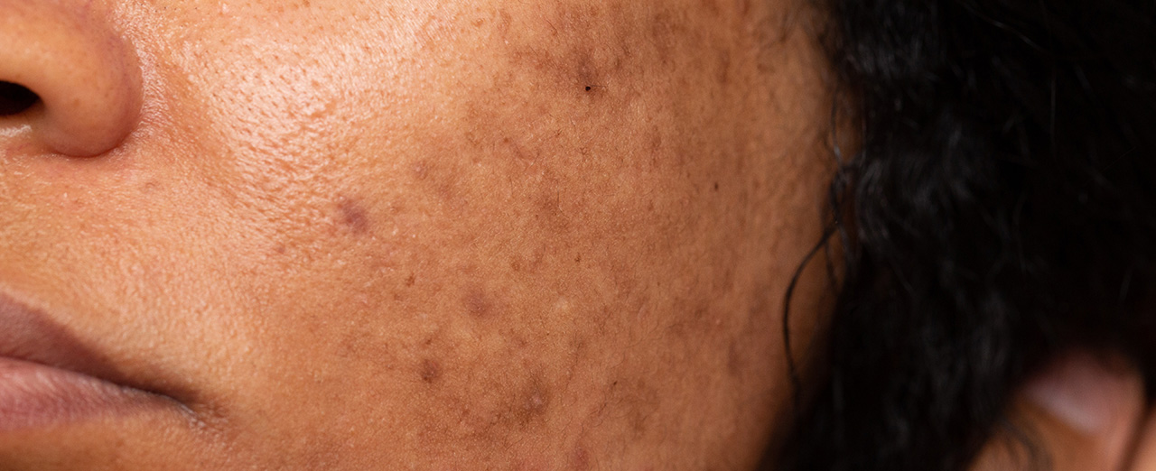 Post Inflammatory Hyperpigmentation (PIH)