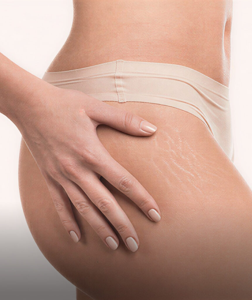 Scars & Stretch Marks default