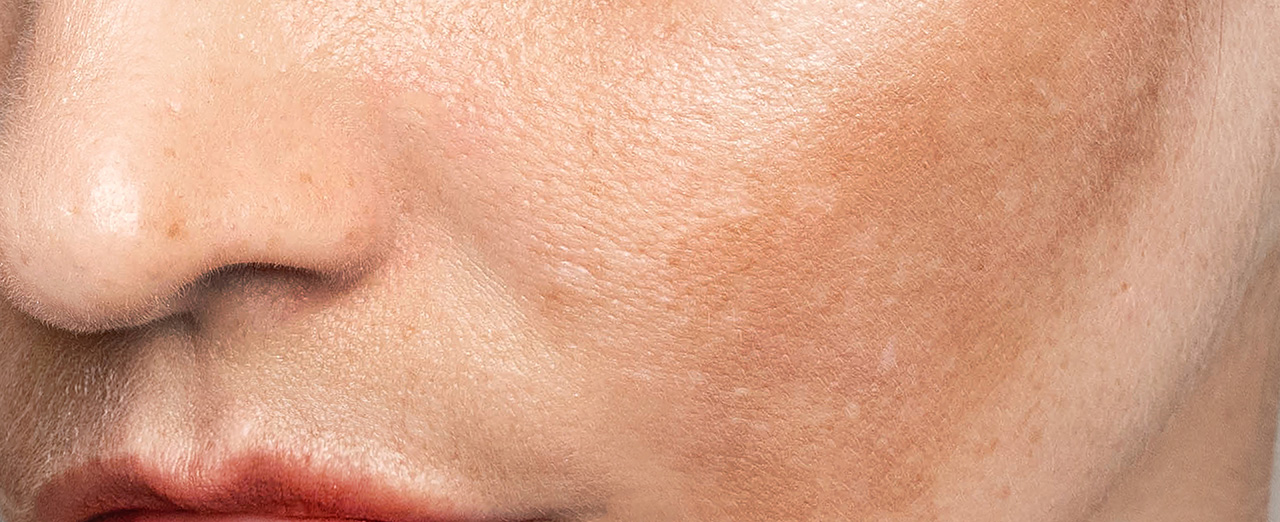 Sun Damage & Age Spots