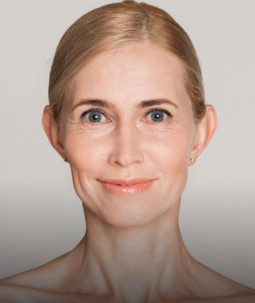 Volume Loss & Hollow Areas default