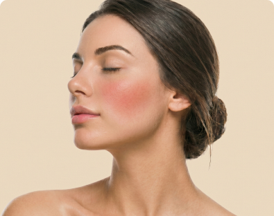 VBeam Redness Treatment