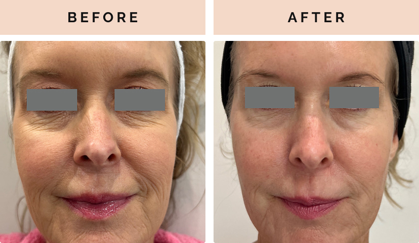before after 9