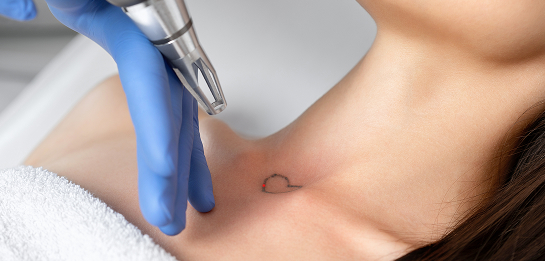 Laser Tattoo Removal