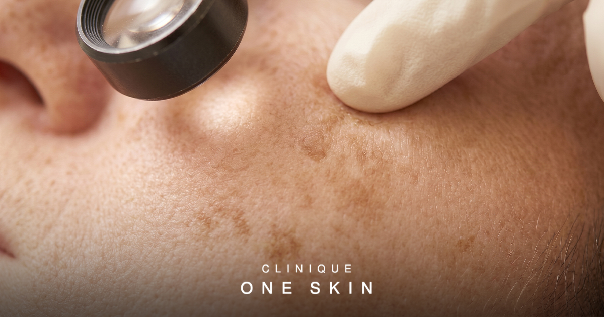 The Medical Approach to Reversing Sun Damage and Hyperpigmentation